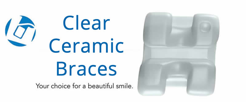 clear braces
